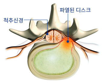 디스크 제거 1단계