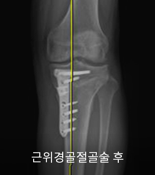 수술 후