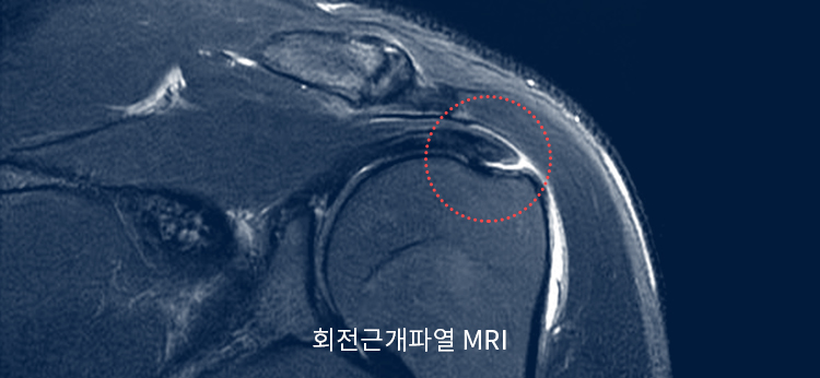 회전근개파열