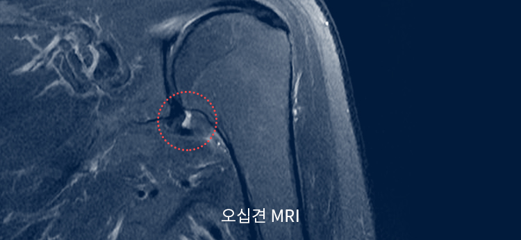 오십견