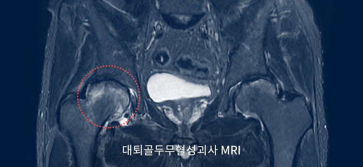 대퇴골두 무혈성괴사