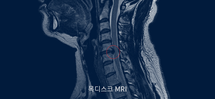 목디스크