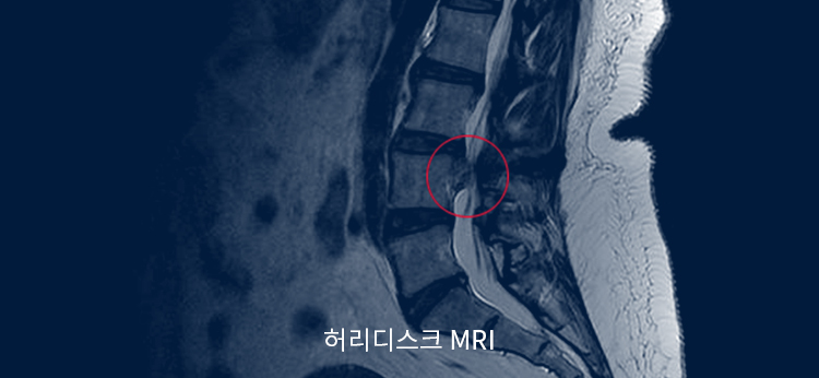 허리디스크