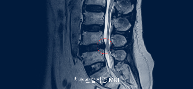 척추관협착증