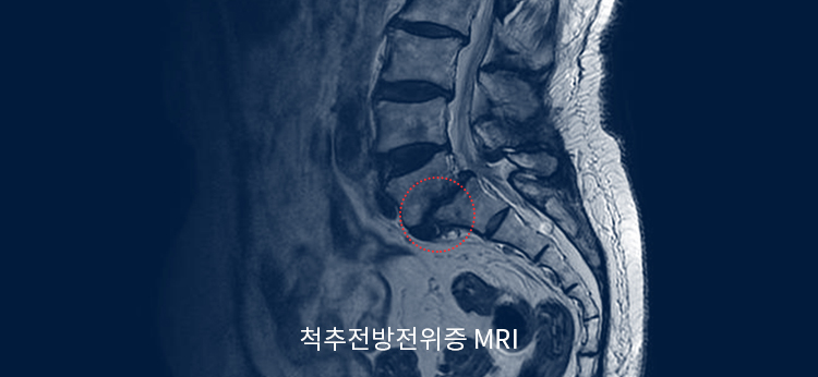 척추전방전위증