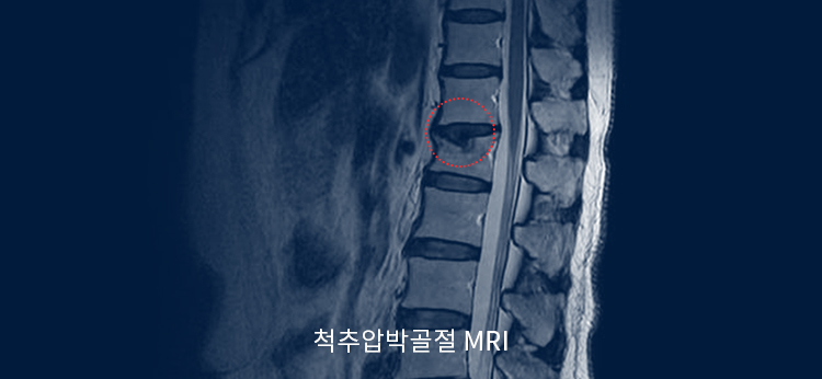 척추압박골절