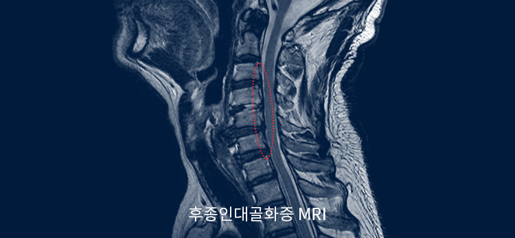 후종인대골화증