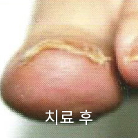 수술 후