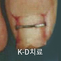 K-D 치료