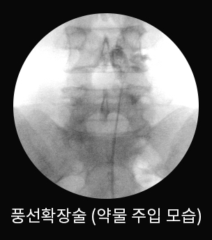 수술 중