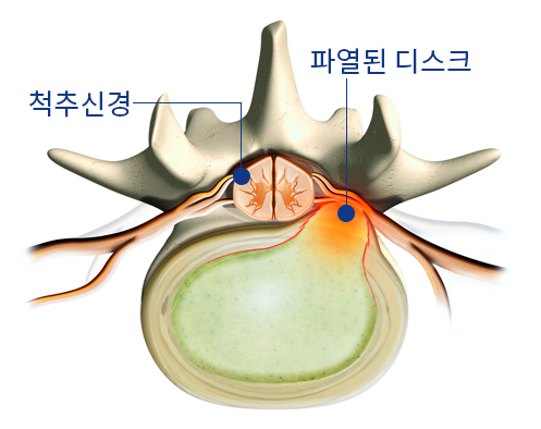 디스크 제거 1단계